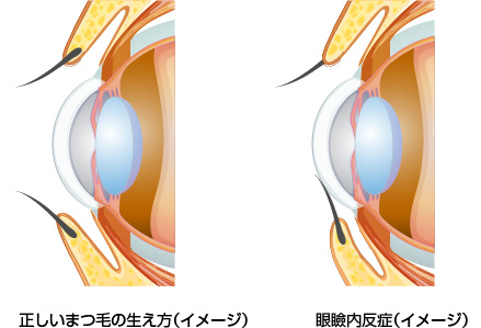 眼瞼内反症