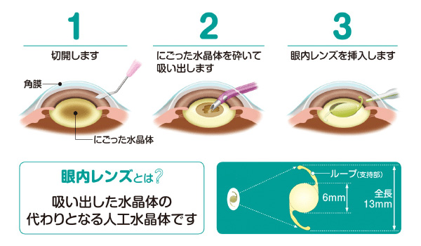 日帰り白内障手術眼内レンズ