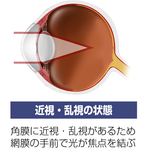 近視・乱視の状態