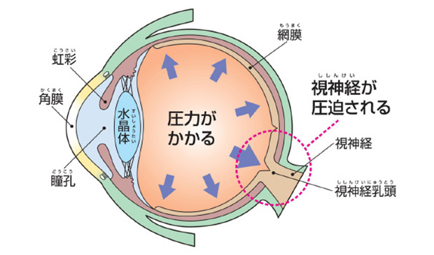 緑内障